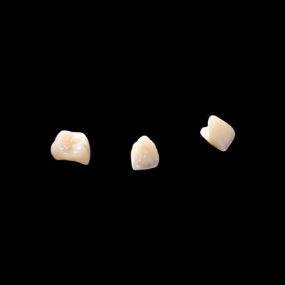 Porcelana CAD/CAM stopiona z mostem z cyrkonia w celu przywrócenia naturalnego wyglądu