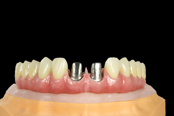 kupować FDA Tytanowy most Implant zębowy Tytanowy ramy z koroną online manufacture