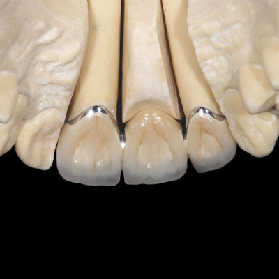 kupować Implant korona PFM niecennego porcelany stopionej do korony metalowej online manufacture