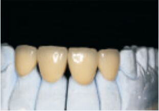 kupować Biała, szlachetna, szlachetna, złożona ze złomu, korona i mostek, precyzyjna i niestandardowa. online manufacture