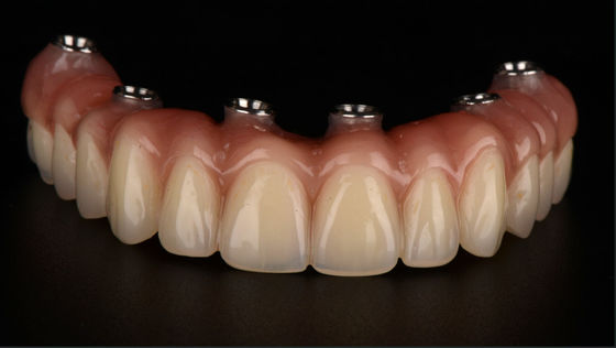 All On X Zęby z implantami Titanowy most Dental CE FDA zatwierdzenie