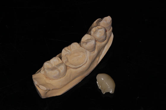 Dental Composite Onlay Veneer Wysoka estetyka Kompozytowy veneer